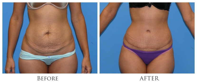 Tummy Tuck Surgery: A Miracle of Modern Medicine in Miami