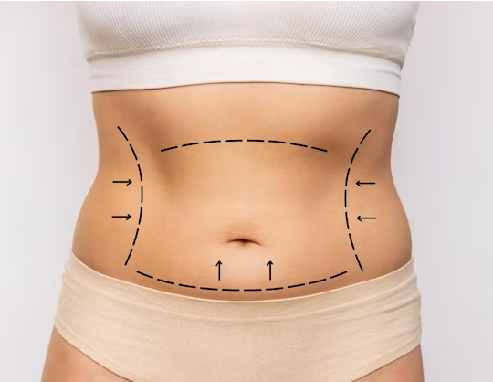 Glamour Redefined: Dive into Miami’s Tummy Tuck Oasis