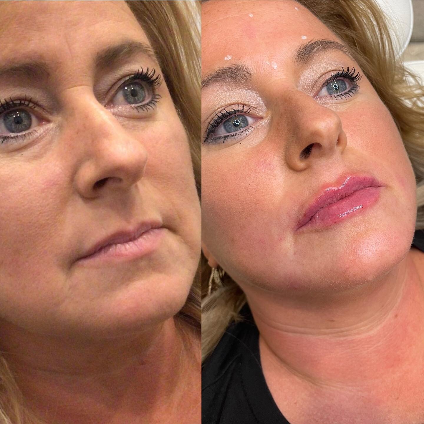 Your Roadmap to More healthy Pores and skin: The Affect of Microneedling PRP